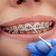 What Are Metal Braces Made Of?