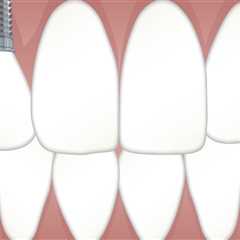 Restore Your Smile with Implants After Tooth Extraction