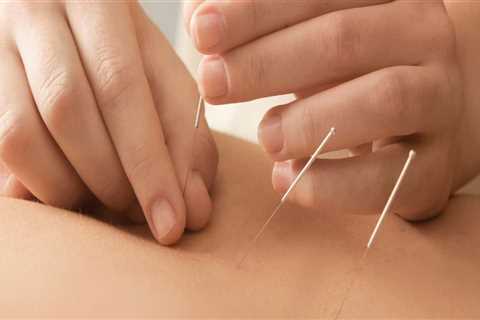Discover the Benefits of Acupuncture for Sleeplessness in Portland
