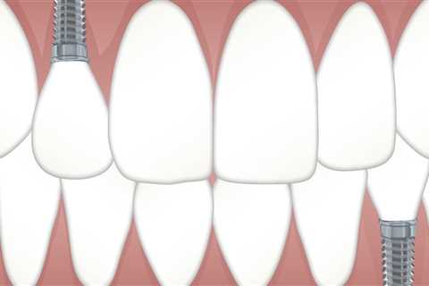Restore Your Smile with Implants After Tooth Extraction