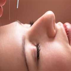 Discover the Benefits of Anti-Aging Acupuncture in Hillarys