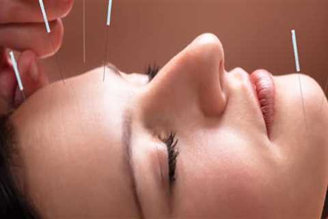 Discover the Benefits of Anti-Aging Acupuncture in Hillarys