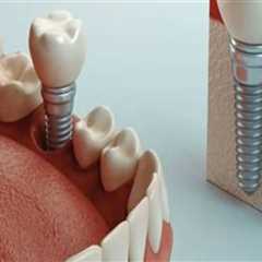 How Teeth Implants Can Influence Chewing Efficiency Beyond Tooth Replacement